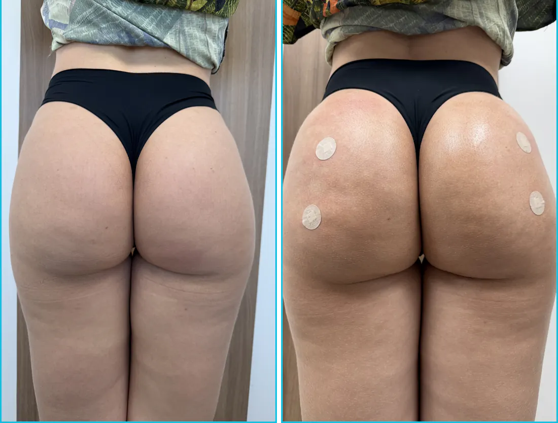 Antes e depois de harmonização glútea em Recife — paciente 2