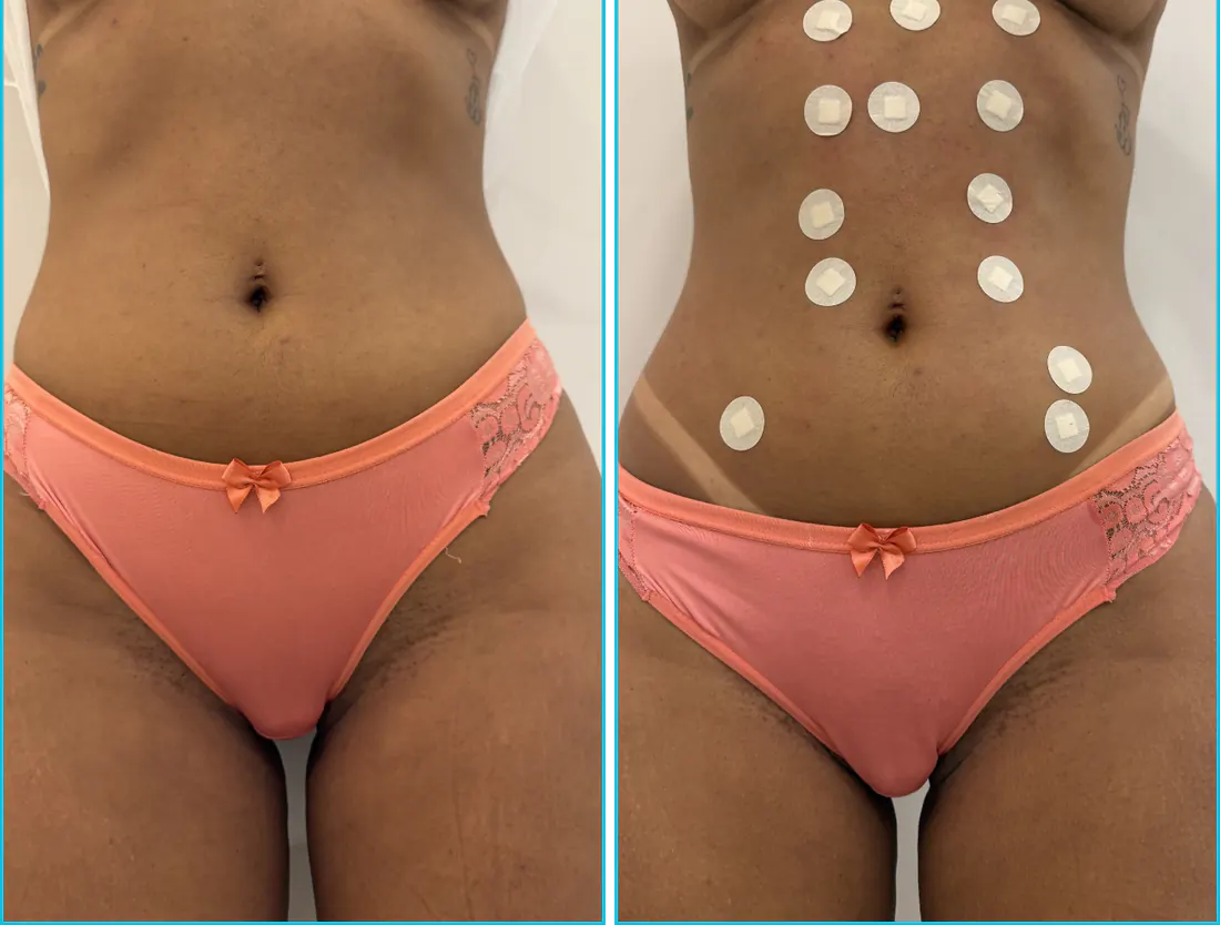 Antes e depois de endolaser em Recife — paciente 1