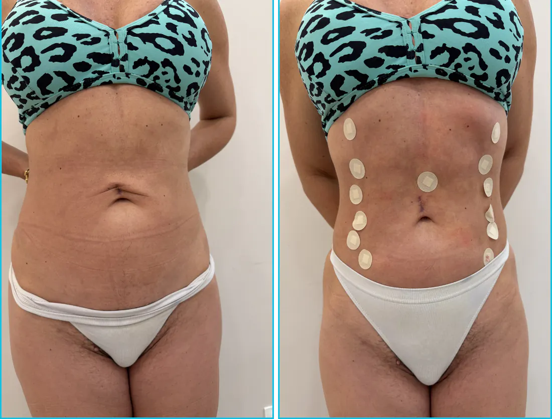Antes e depois de endolaser em Recife — paciente 2