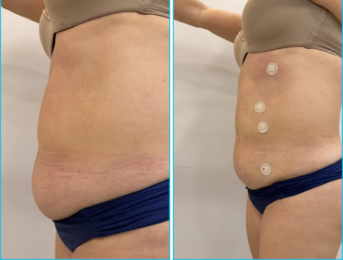 Antes e depois de endolaser em Recife — paciente 3