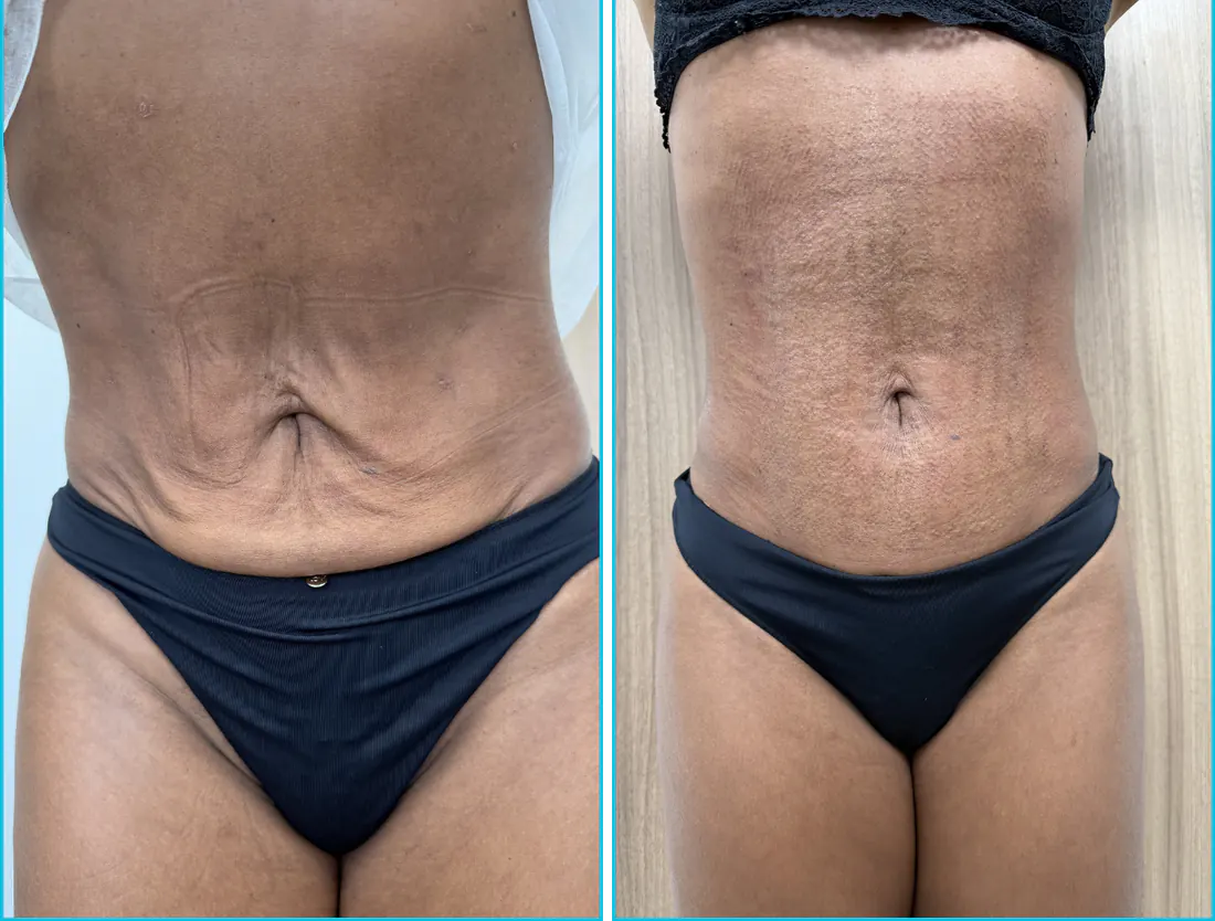 Antes e depois de endolaser em Recife — paciente 4