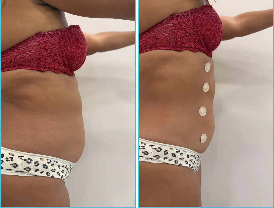 Antes e depois de endolaser em Recife — paciente 5