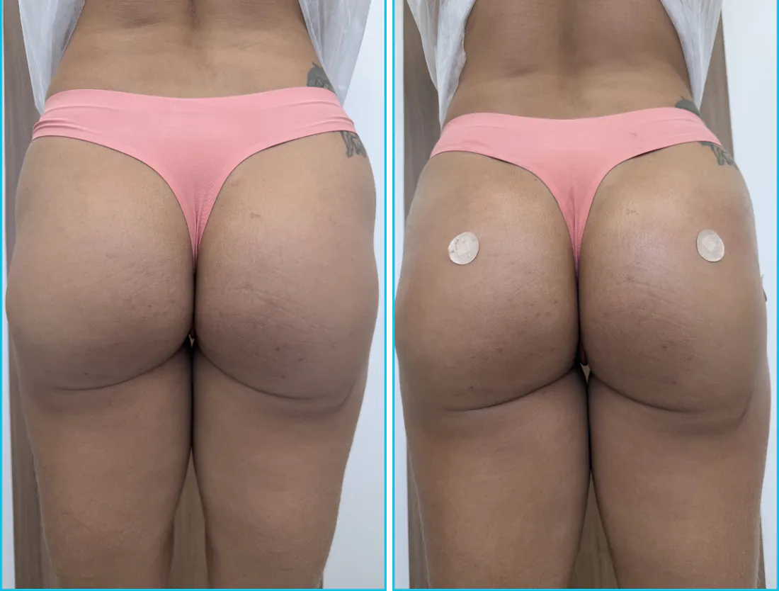 Antes e depois de harmonização glútea em Recife — paciente 3