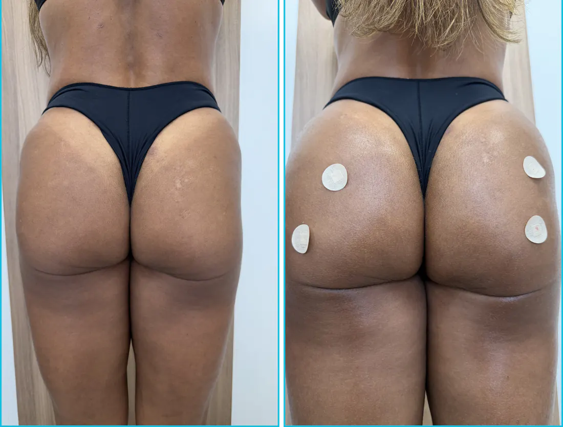 Antes e depois de harmonização glútea em Recife — paciente 4