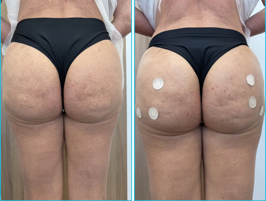 Antes e depois de harmonização glútea em Recife — paciente 5