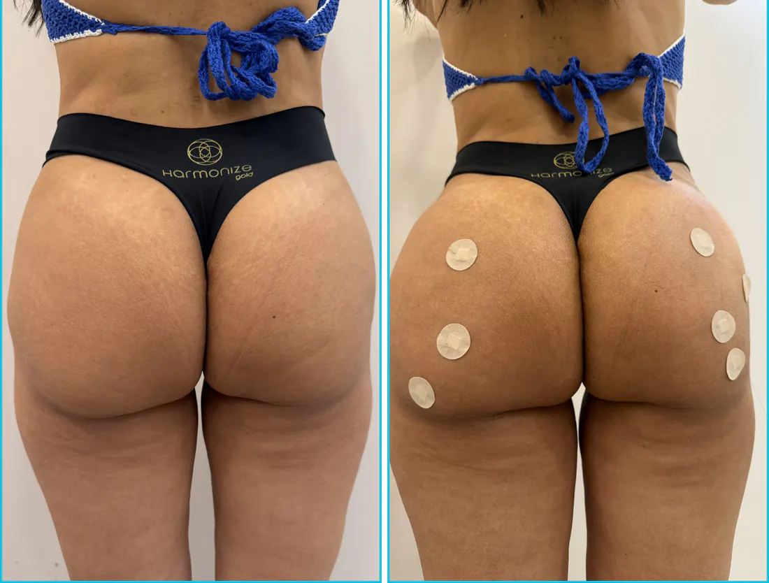 Antes e depois de harmonização glútea em Recife — paciente 6