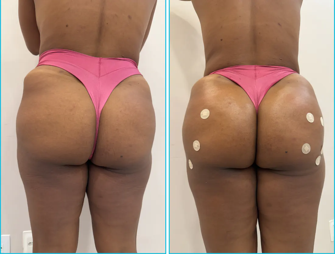 Antes e depois de harmonização glútea em Recife — paciente 7
