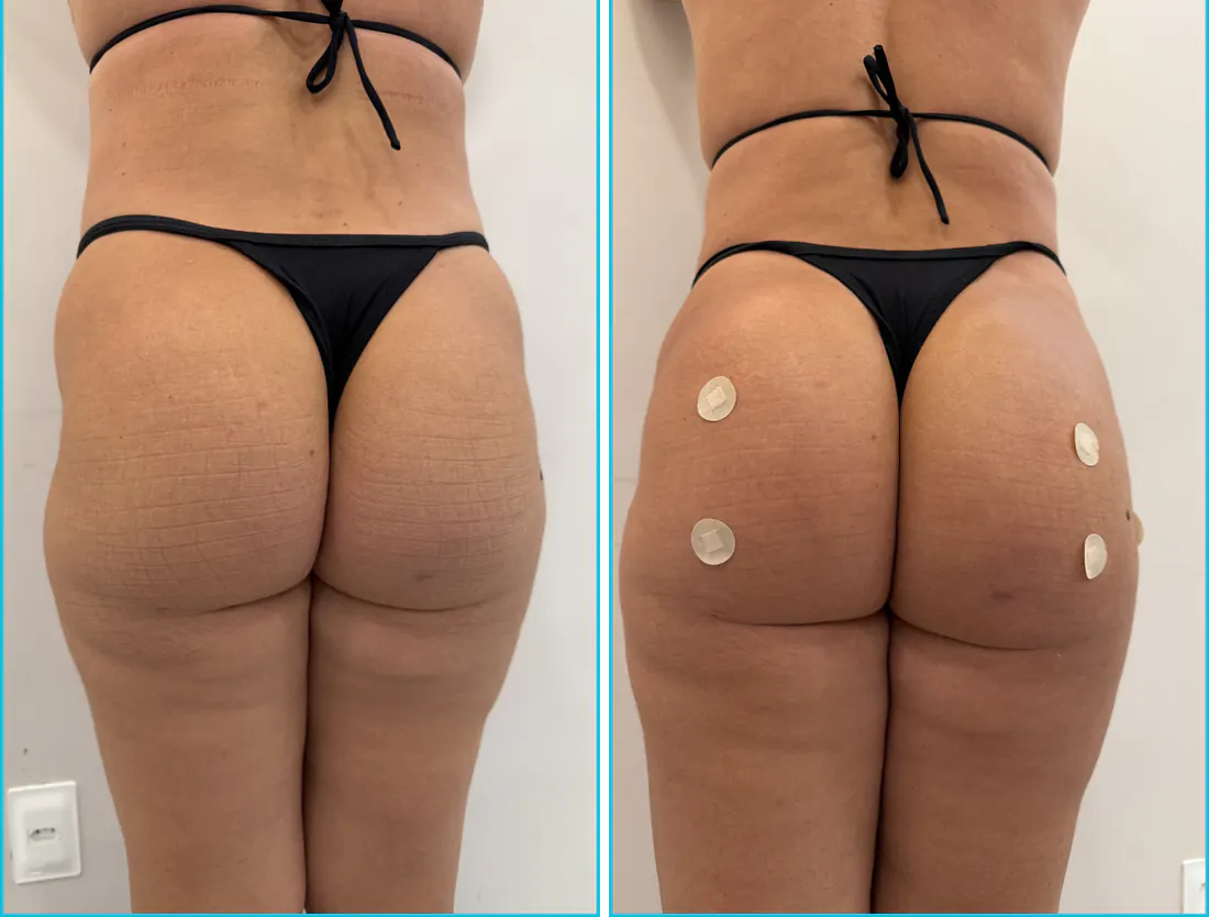 Antes e depois de harmonização glútea em Recife — paciente 8