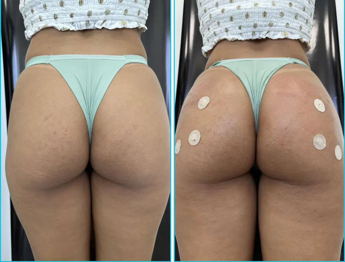 Antes e depois de harmonização glútea em Recife — paciente 9