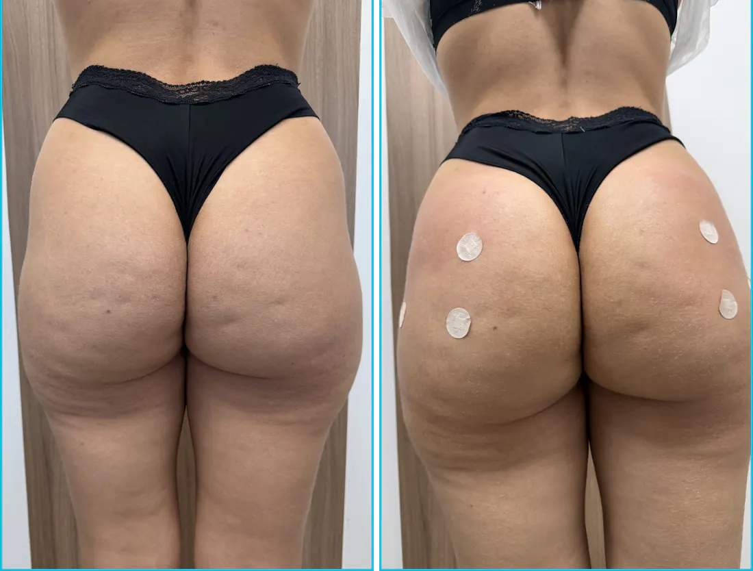 Antes e depois de harmonização glútea em Recife — paciente 10